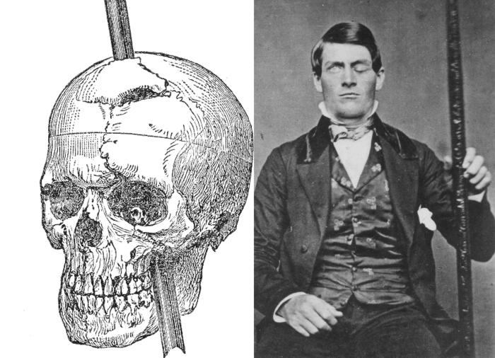 Was phineas gage lucky or unlucky